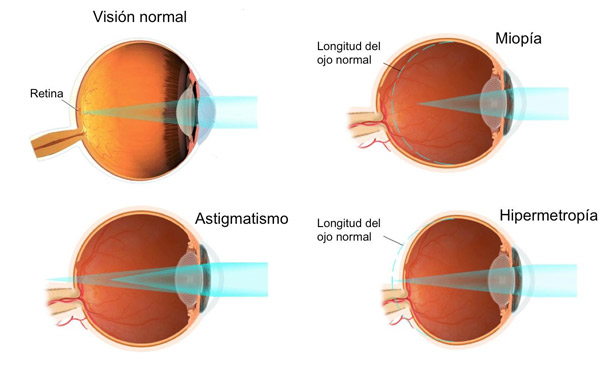 Agudesa visual i refracció